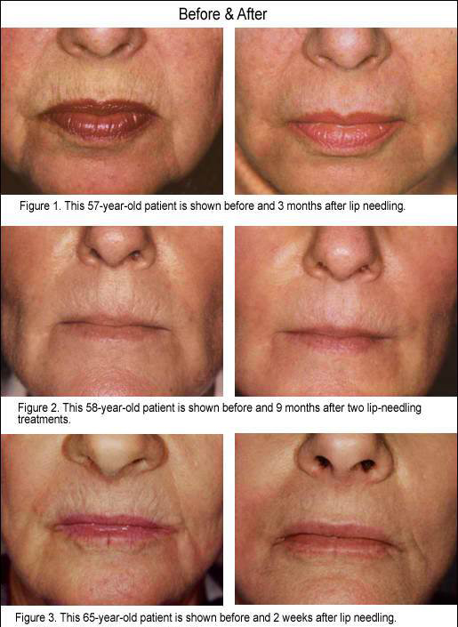 dermapen lip wrinkles
