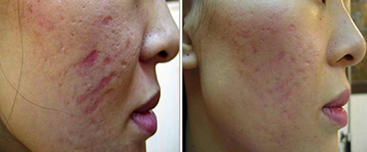 dermapen facial scar