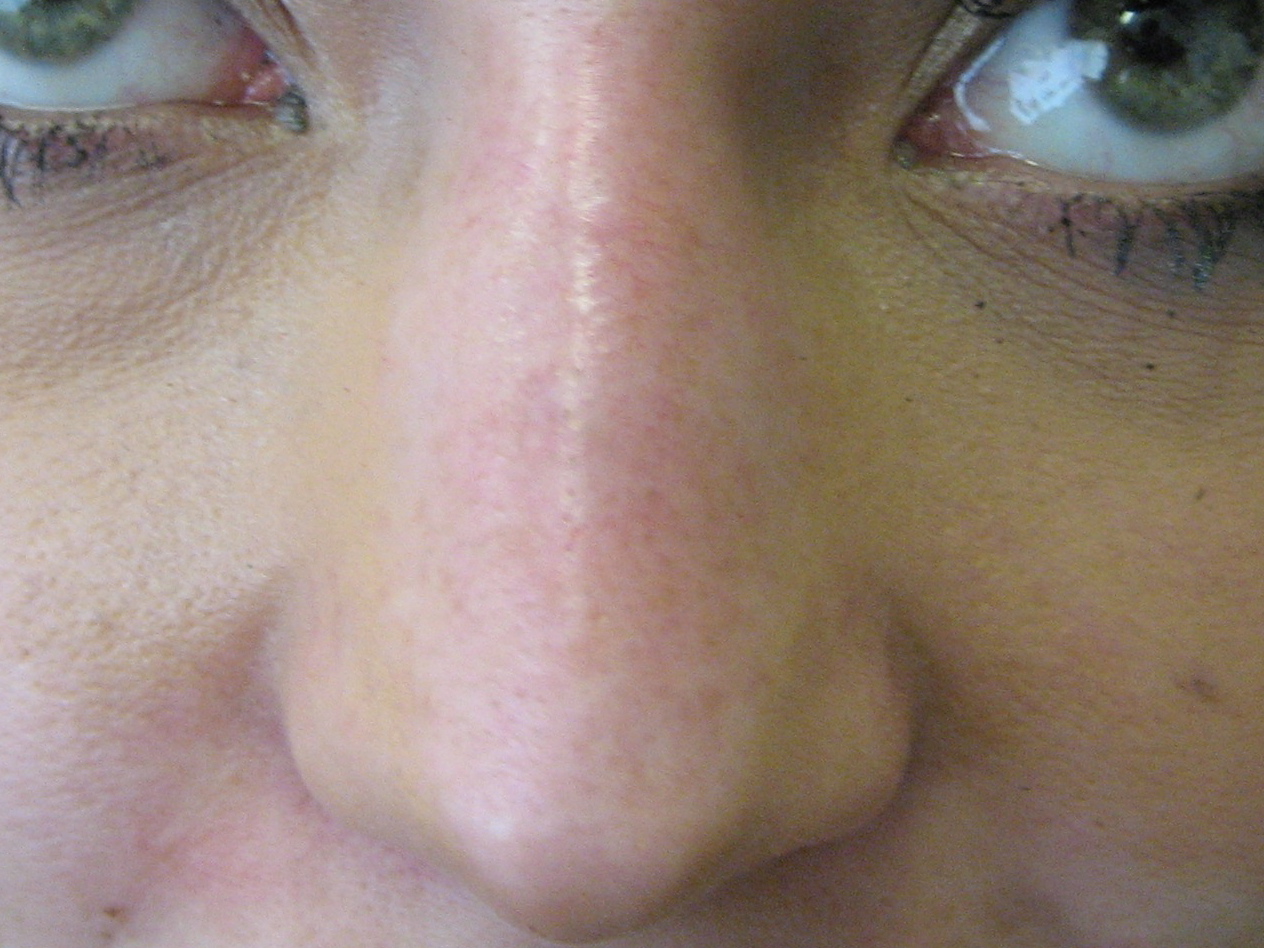 nose treatment with restylane