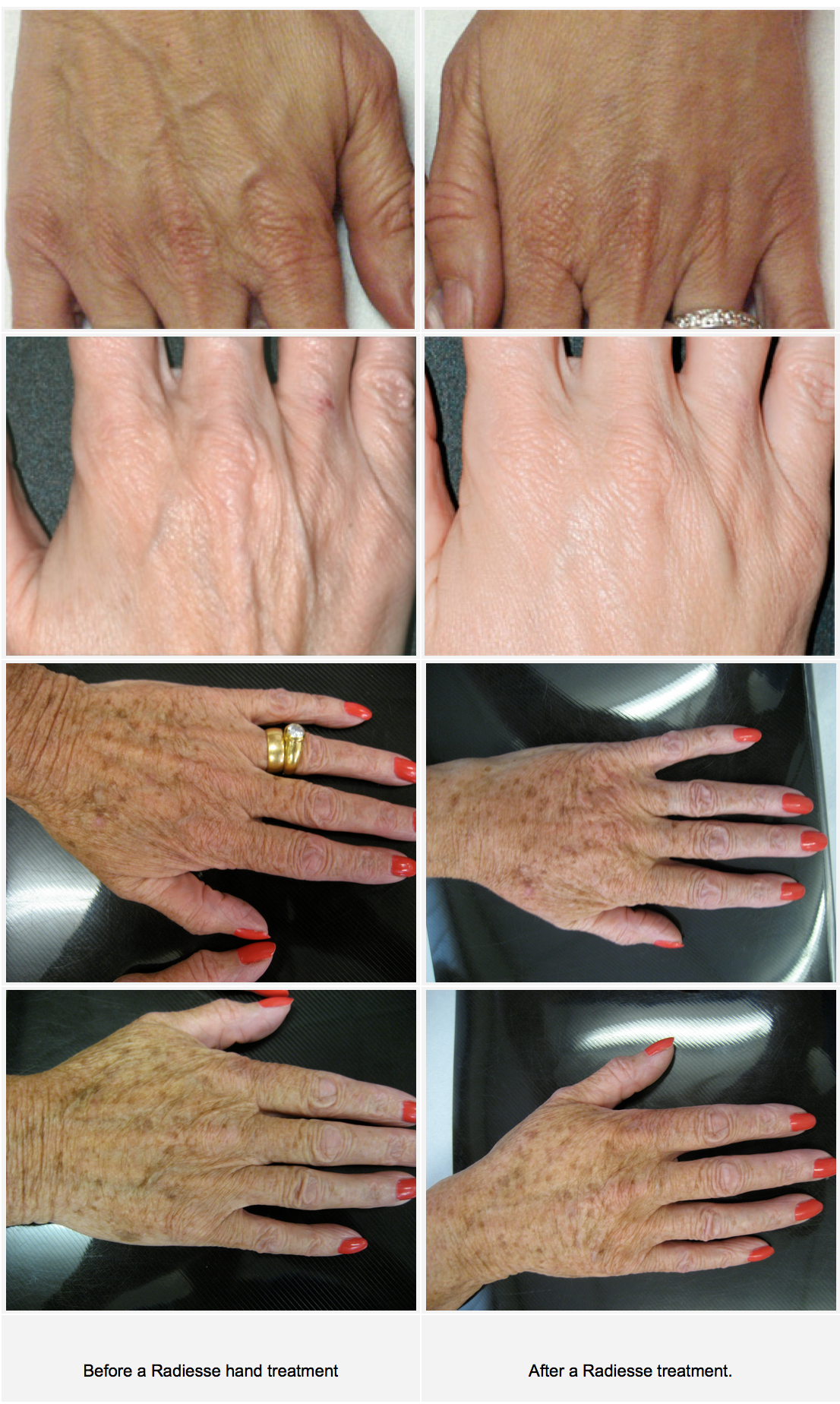 Radiesse Hand Rejuvenation treatment