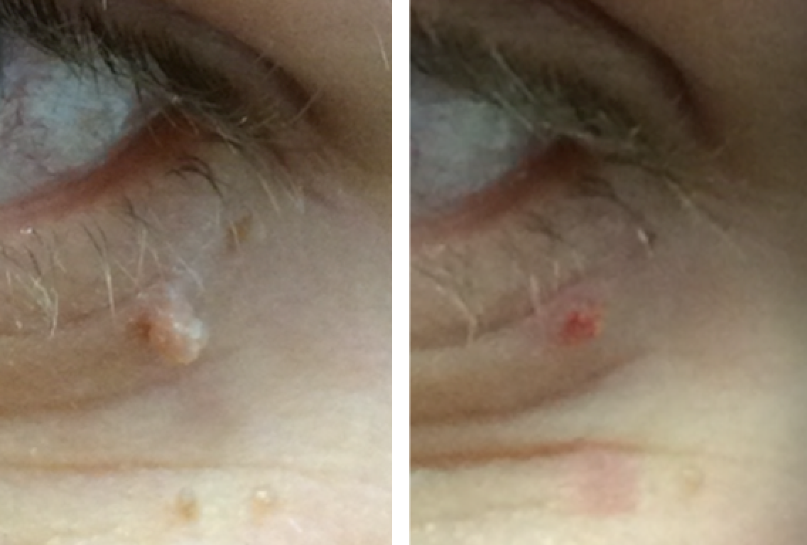 before and after skin tag removal Cheshire