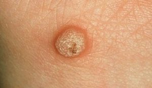 Wart Removal