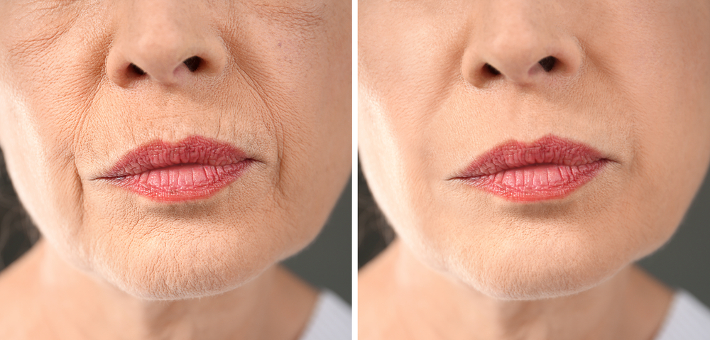 Restoring the ageing face by Dr Teri Johnson Cheshire