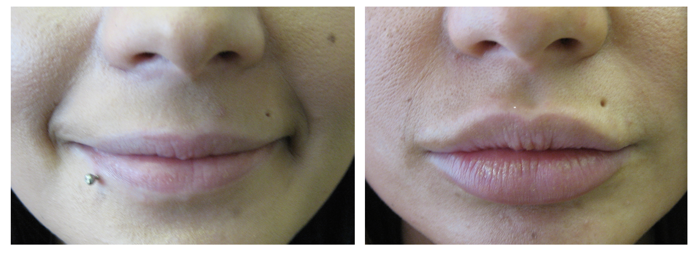 Lip enhancement Dr Teri Middlewich Cheshire