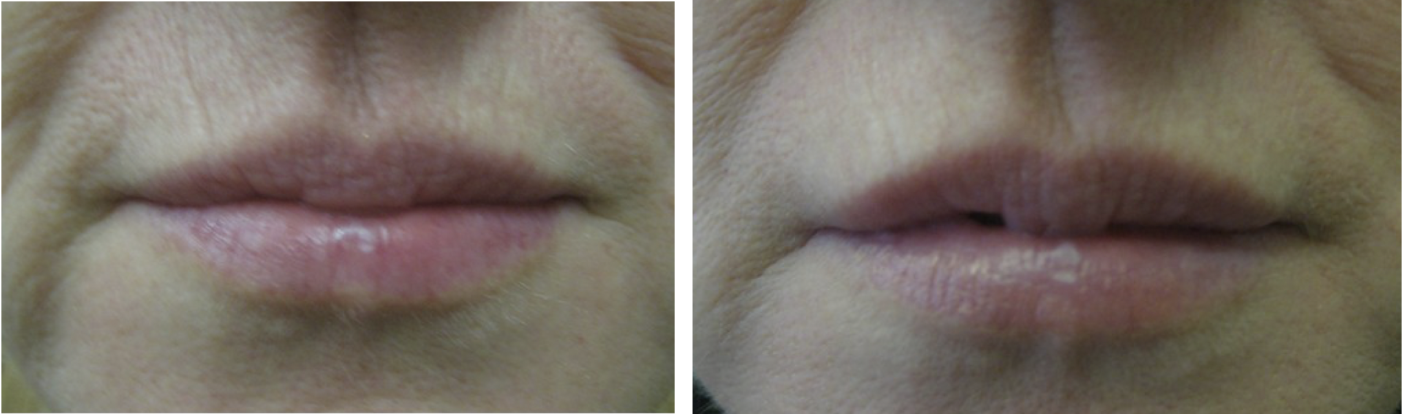 Lip Rejuvenation Cheshire Dr Teri