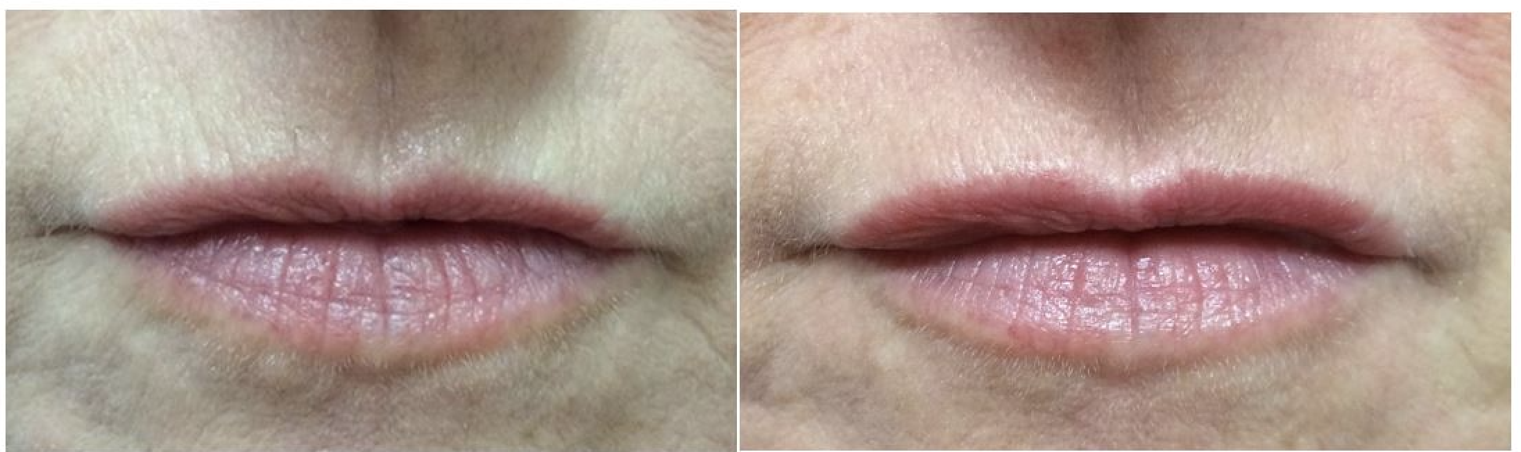 lip rejuvenation Dr Johnson middlewich