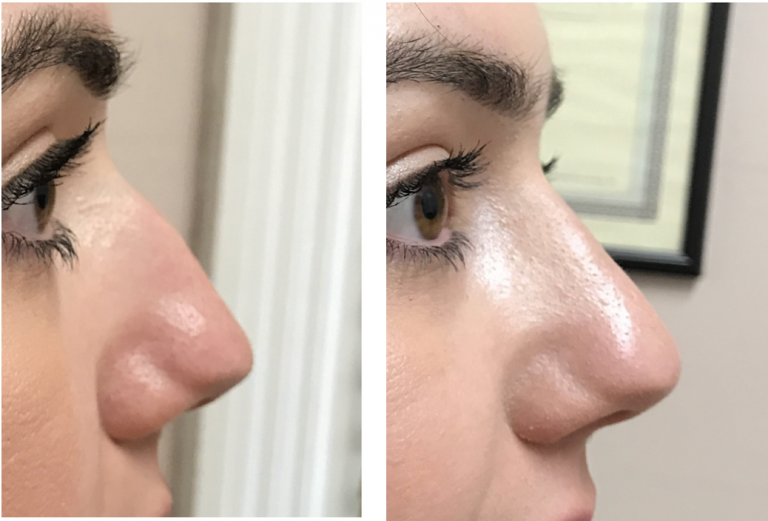 Nose Correction by Dr Teri Johnson at Cheshire Lasers