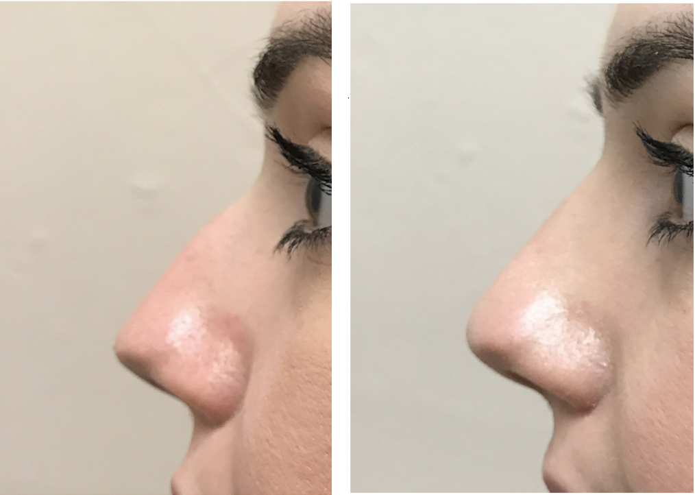 Dr Teri Cheshire nose correction dermal fillers