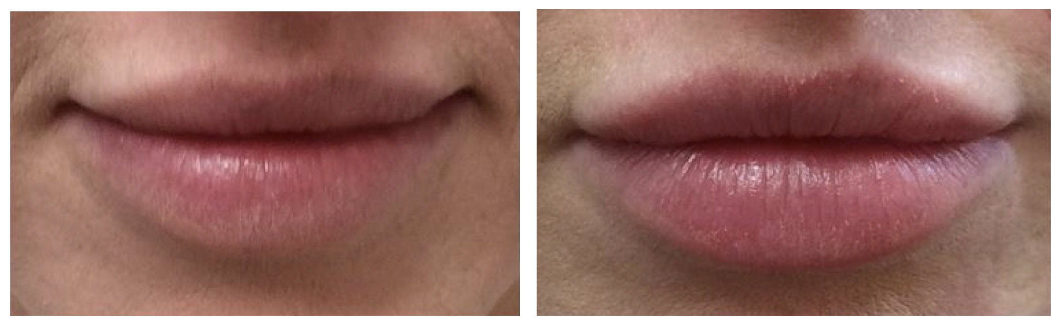 lip enhancement doctor Cheshire