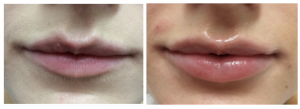 lip enhancement Cheshire doctor
