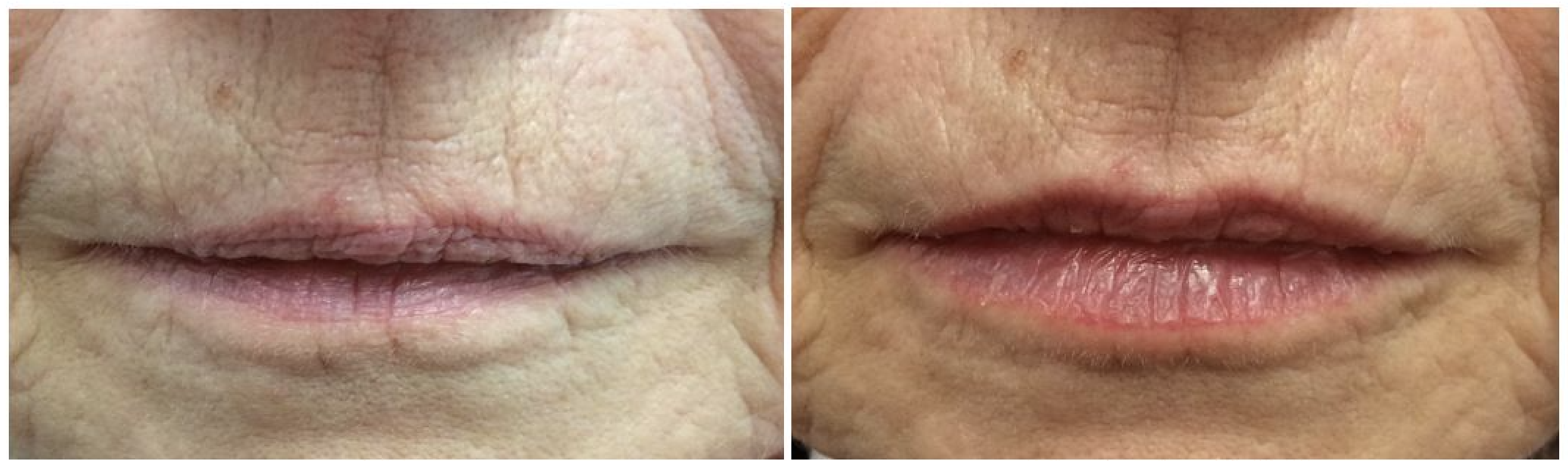 lip rejuvenation smokers line filler Cheshire