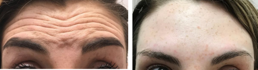 raising eyebrows before and after botox cheshire lasers