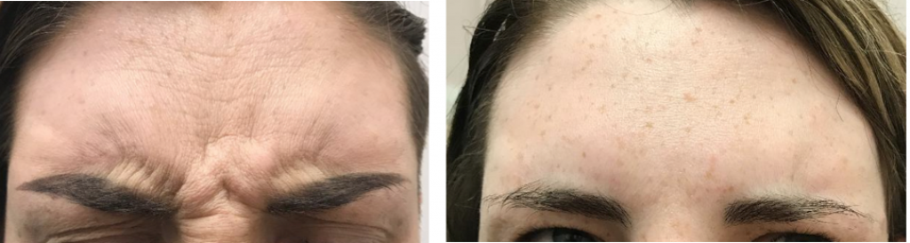 before and after Botox frown treatment Cheshire lasers