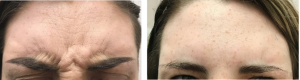 before and after Botox frown treatment Cheshire lasers