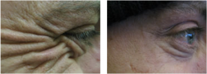 botox man crows feet at Cheshire Lasers