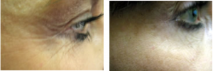 before and after botox crows feet middlewich