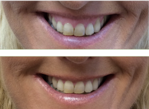 before and after botox treatment for gummy smile