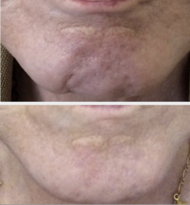 Botox chin dimple treatment