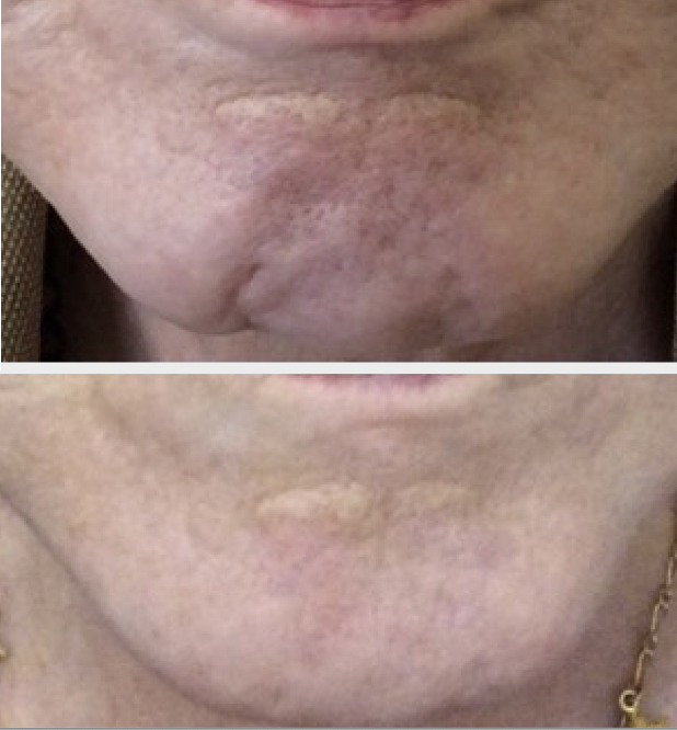 Botox chin dimple treatment