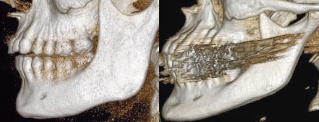 bony changes to the chin