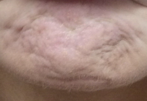 Chin dimples caused by a hyperactive mentalis muscle dimply chin