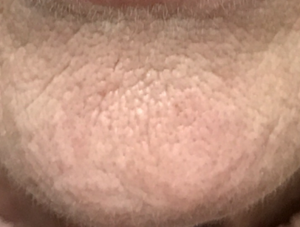 Dynamic chin wrinkles cobblestone chin