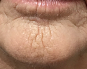 Dynamic chin wrinkles mental crease chin