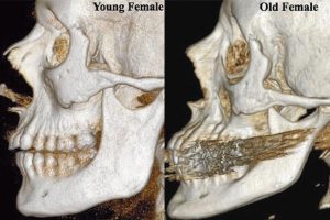 bone changes with age in a female