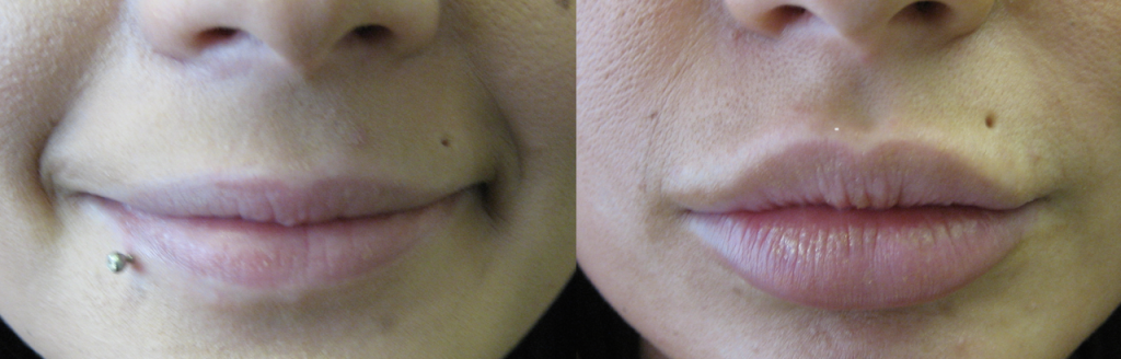 before and after lip enhancement treatment