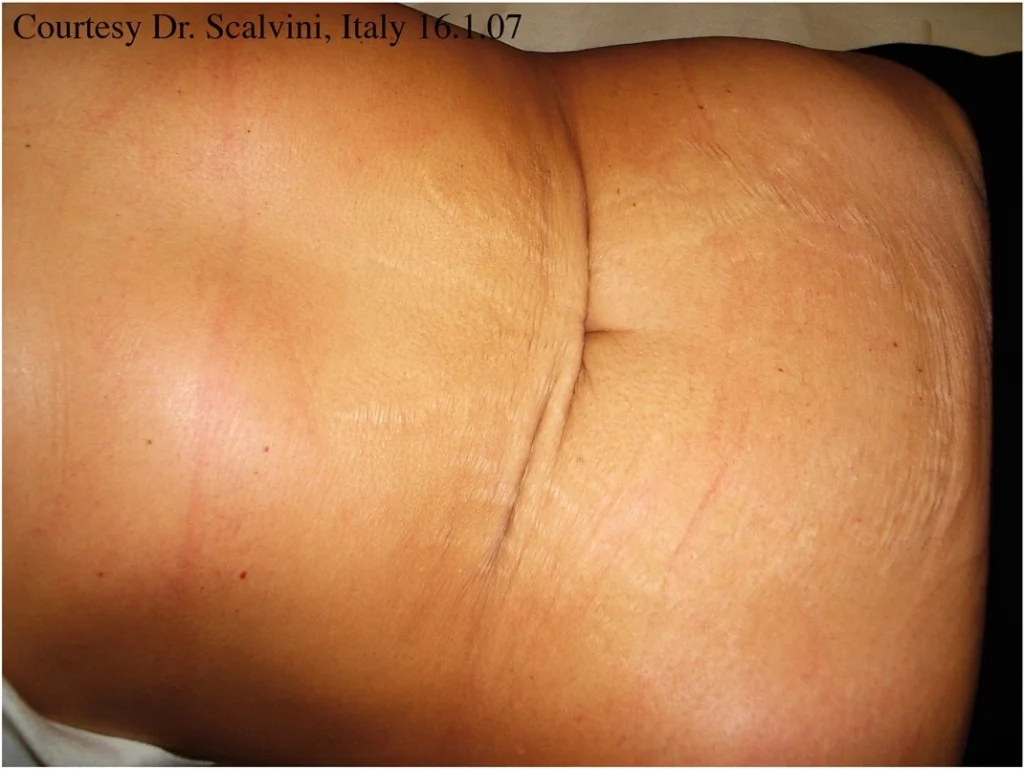 Stretch Marks before treatments