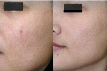 Dermaroller acne scars