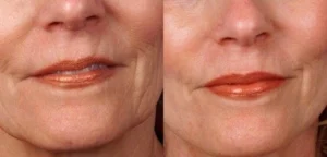 Before and after derma pen for ageing and wrinkles
