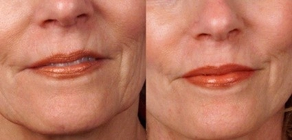 Before and after derma pen for ageing and wrinkles